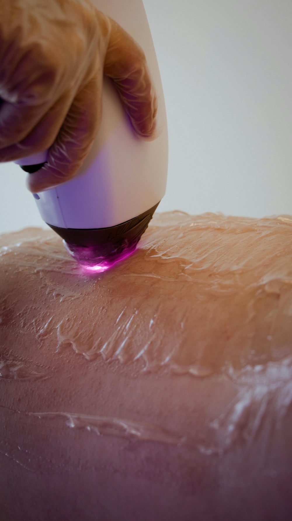 Diodenlaser während einer kosmetischen Haarentfernung